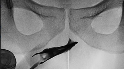 شاب يعيش بملقاط عالق في مجرى البول منذ 4 سنوات