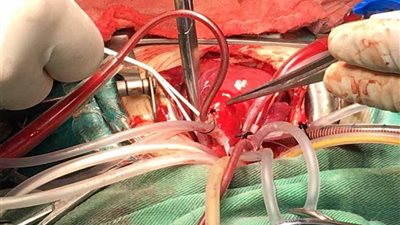 الإسكندرية تستقبل المؤتمر الأول لمركز جراحة الأوعية الدموية والقلب