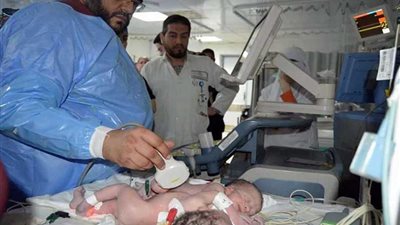 لأول مرة.. ولادة توأم ملتصق بمستشفى أطفال المنصورة (صور)