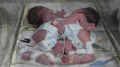 استقرار حالة توءم المنصورة الملتصق