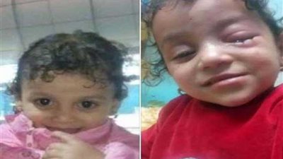 شقيقان يسكبان مادة كاوية على طفلة في الشرقية