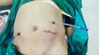 استئصال ورم من معدة مريض باستخدام المنظار الجراحي