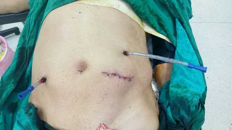 استئصال ورم من معدة