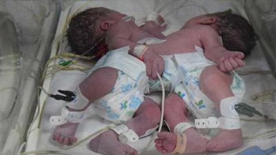 وفاة أحد الطفلين الملتصقين أثناء فصلهما بمستشفى المنصورة