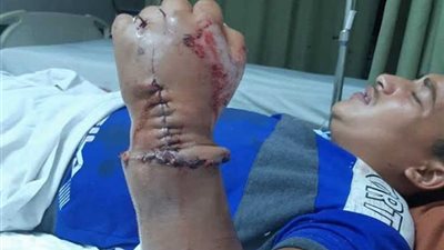 عاجل.. جامعة أسيوط تنجح فى زرع يد شاب بعد بترها بالكامل.. صور