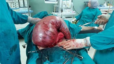 يزن 15 كيلوجراماً.. استئصال ورم ضخم من رجل بمستشفى التأمين الصحي بالمنيا.. (صور)