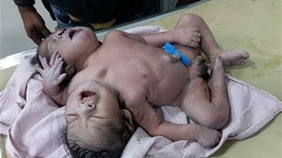 نادرة جدا.. ولادة طفل برأسين وثلاثة أذرع وجسد واحد