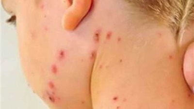 ارتفاع ضحايا وباء الحصبة في ساموا إلى 42 قتيلا