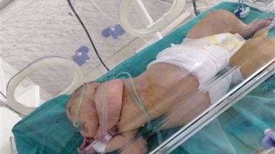 صحة الشرقية: استمرار إجراء الجراحات العاجلة للأطفال بمستشفى الزقازيق العام