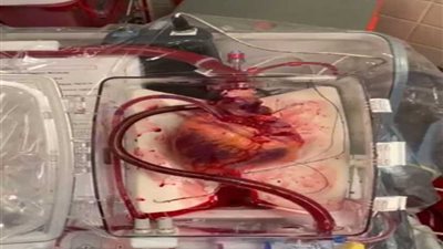 أول عملية زرع قلب من 