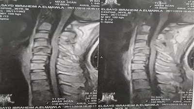 عاجل.. جراحة نادرة بمستشفى العامرية غرب الإسكندرية