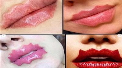 شفاه الشيطان.. خبراء التجميل يحذرون من عواقبها