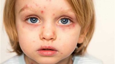 إصابة 75 تلميذا بالجديري المائي و2 بالتهاب في المخ بمدارس أسيوط