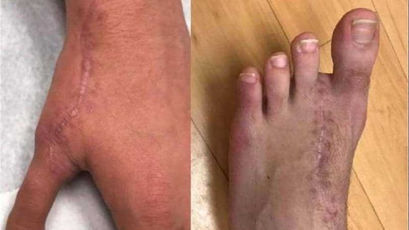 إصبع قدم بدلا من