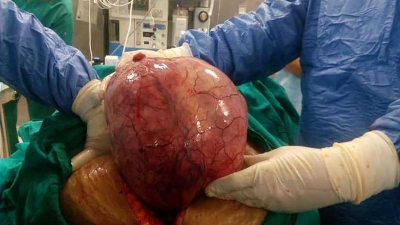 عاجل.. استئصال ورم