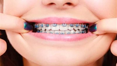 3 معلومات مغلوطة عن تقويم الأسنان