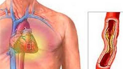 تعرف على أفضل طريقة لعلاج انسداد الشرايين