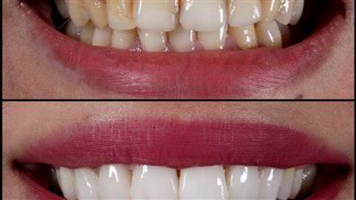  أكاذيب تجارية حول عدسات الأسنان التجميلية 