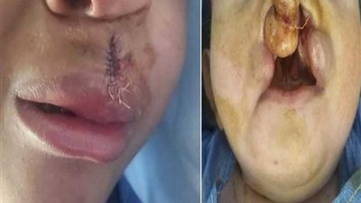 بدء العمليات التجميلية بمستشفى العجمي العام