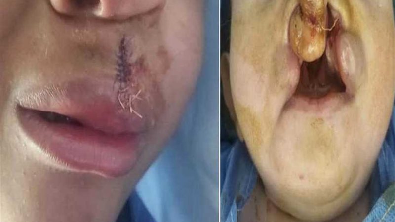 بدء العمليات التجميلية