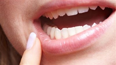 ٥ أسباب لالتهاب جذور الأسنان.. وطريقة علاجه