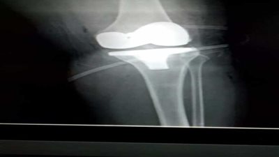 على نفقة الدولة.. مفصل صناعي لـ