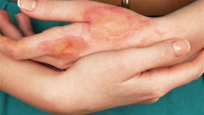 أخصائي جلدية: يجب عدم استخدام الكلور لتطهير الجلد لأنه ضار جدًا