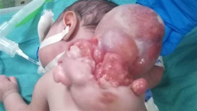 فصل توءم ملتصق غير مكتمل بمستشفى المنصورة الدولي