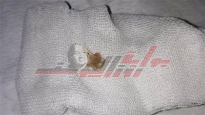 بنها الجامعى تنجح فى استخراج 