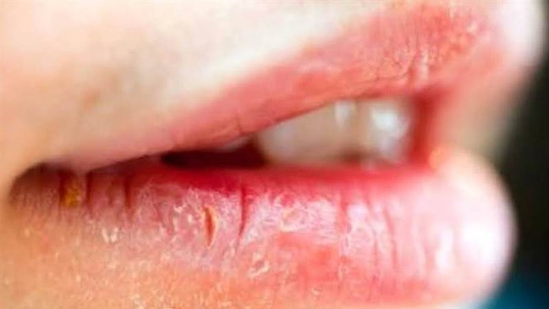 تشقق الشفاه