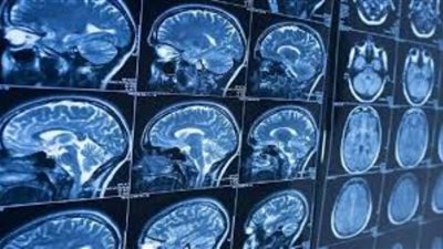 بحث يبعث على التفاؤل .. العلماء ينجحون في إصلاح أضرار السكتة الدماغية