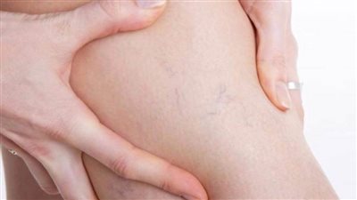 وليد الدالي: ضيق الأوعية الدموية نتيجة مرض الشرايين المحيطة