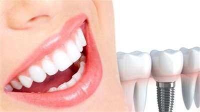 تعرف على المدة المطلوبة لزراعة الأسنان بعد خلعها