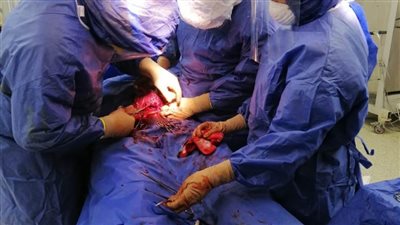  نجاح أول عملية ولادة قيصرية لمريضة كورونا بمستشفى الإسماعيلية العام