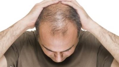 الصلع5 أسباب تؤدي إلى تساقط الشعر