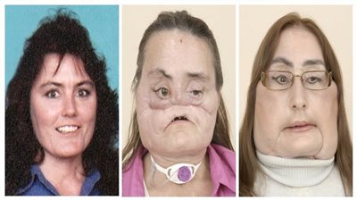 وفاة أكبر مريضة خضعت لعملية زرع وجه فى العالم 