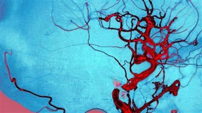 نوع من الخضار يحد تناوله من مرض خطير!