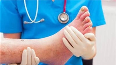 تعرف على كيفية تسليك شرايين القدم بعد انسدادها