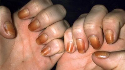 خبير أورام  روسي يوضح  كيفية التنبؤ بالسرطان بمعاينة الأظافر