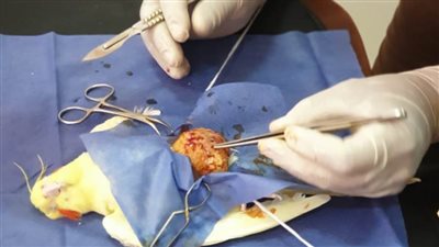 استئصال ورم من طائر بكلية 