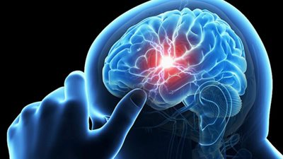 طبيب روسي يكشف أعراض الجلطة الدماغية