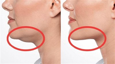 استشاري جراحة تجميل يكشف عن الحل الأمثل لعلاج منطقة 