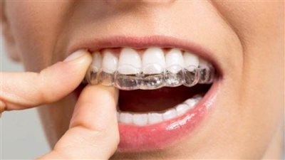 أخصائي تجميل يكشف عن فوائد تقويم الأسنان  (فيديو)