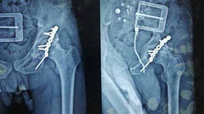 نجاح جراحة دقيقة لتغيير مفصل مريض بمستشفى المنصورة الدولي