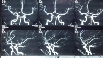 إنقاذ حياة طفلة بعد إصابتها بنزيف في المخ بمستشفى المنصورة الدولي