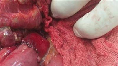 نجاح عمليتين جراحيتين أجريتا  لأول مرة