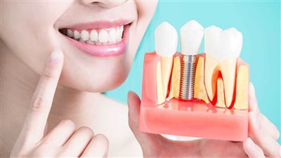 هؤلاء ممنوعون من زراعة الأسنان .. تعرف عليهم