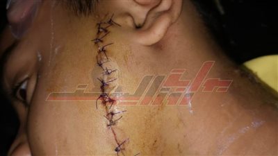 حبس طفل 4 أيام على ذمة التحقيقات بسبب إحداث 36 غرزة لطفل آخر بالشرقية
