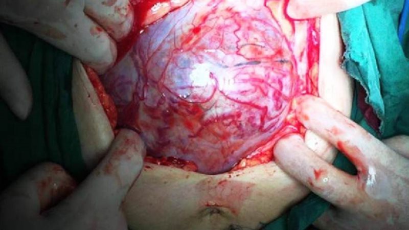 انفجار الرحم لدى