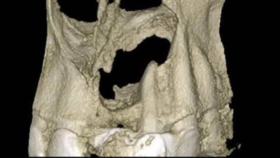 استئصال كيس من فك مريض بمستشفى ميت غمر 